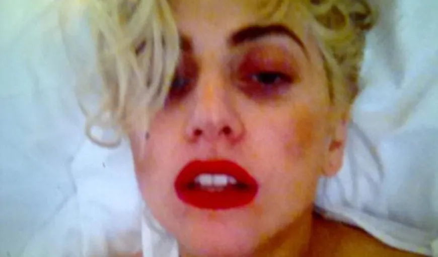 Lady Gaga ne arată pe Twitter ochiul său vânăt, după accidentul de pe scenă FOTO