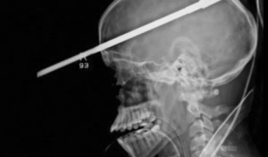 Un adolescent a scăpat cu viaţă, după ce o suliţă i-a străpuns cutia craniană VIDEO