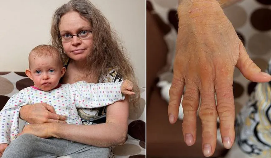 Drama unei femei care dă jos 12 kilograme de piele în fiecare an. Fiica ei i-a moştenit boala