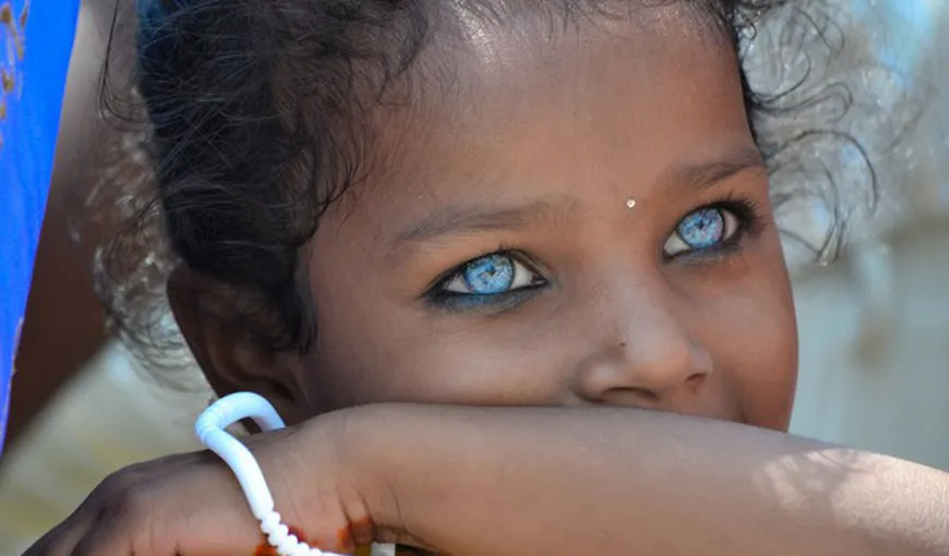 DRAMA din spatele celor mai frumoşi ochi din lume. Povestea tristă a fetiţei cu ochi de diamant