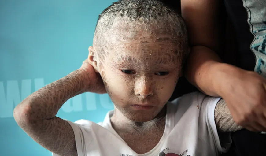 Povestea băiatului-PEŞTE, cu pielea acoperită de solzi. Medicii nu pot să-l vindece