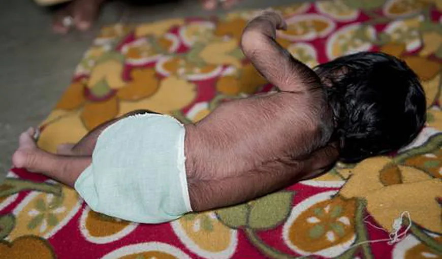 „Sindromul vârcolacului”: Imaginile care au cutremurat lumea
