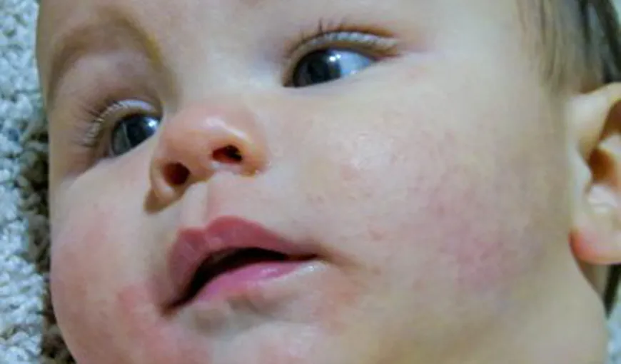 Totul despre dermatita atopică la copii