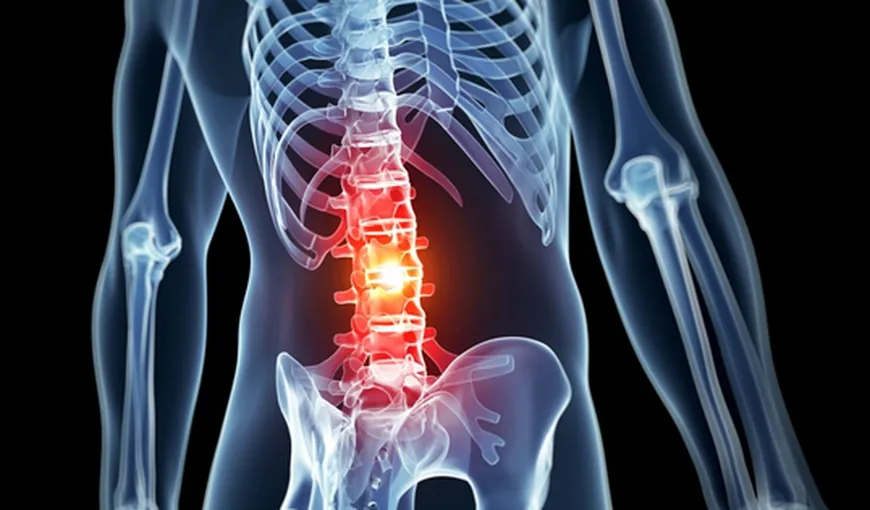 9 remedii naturale pentru dureri de spate