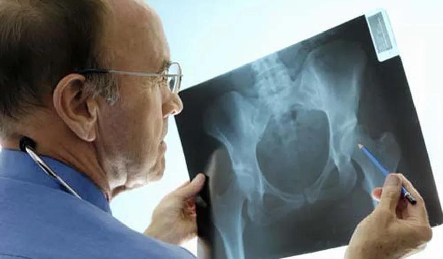 Despre osteoporoză: Tot ce trebuie să ştii despre „boala mută”