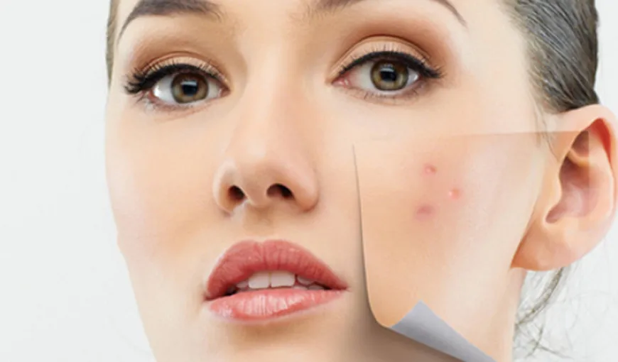 Dr. Oana Spânu: Cele mai mari greşeli pe care le facem când avem acnee