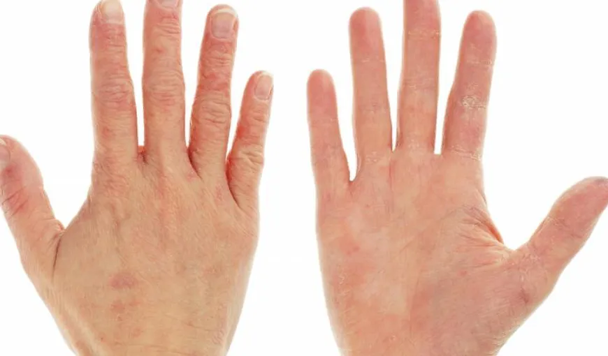 Ai mâinile aspre şi crăpate sau unghiile exfoliate? Vezi ce boli trădează aspectul mâinilor