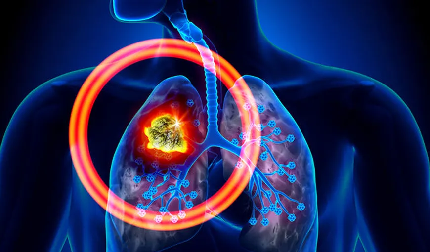 Cancerul pulmonar. 8 simptome pe care nu ar trebui să le ignori