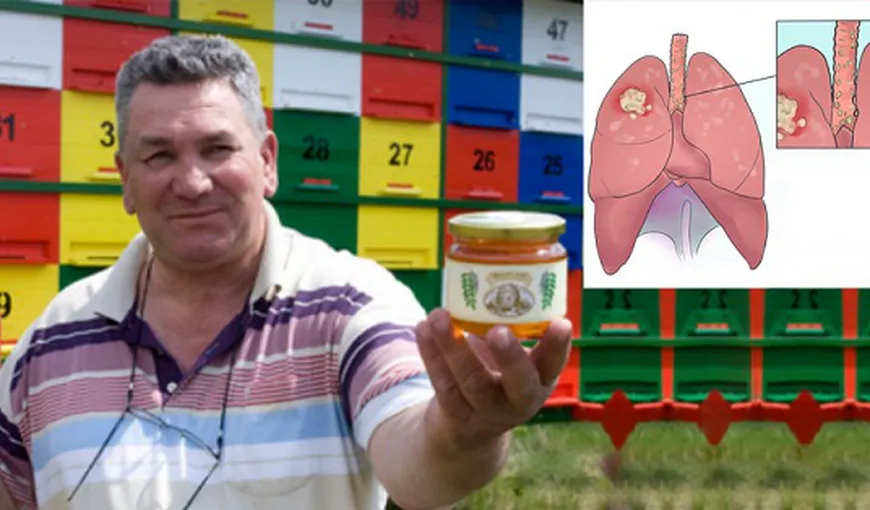 Mierea de albine, remediul natural care a vindecat un bărbat de cancer