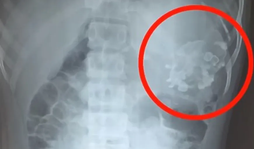 ŞOCANT. Un fetus de 2,5 kilograme a fost scos din abdomenul unui adolescent VIDEO