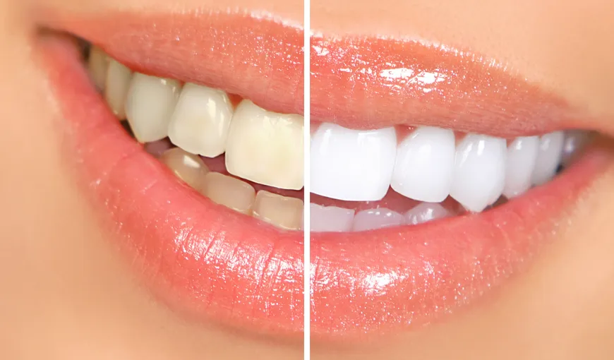 Albirea dentară nu afectează dinţii