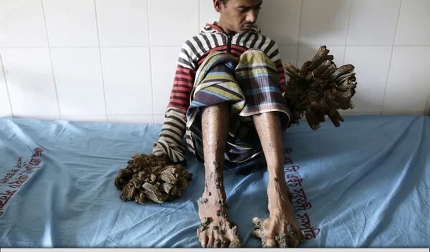 „Omul-copac” cu tumori pe mâini şi pe picioare va fi operat