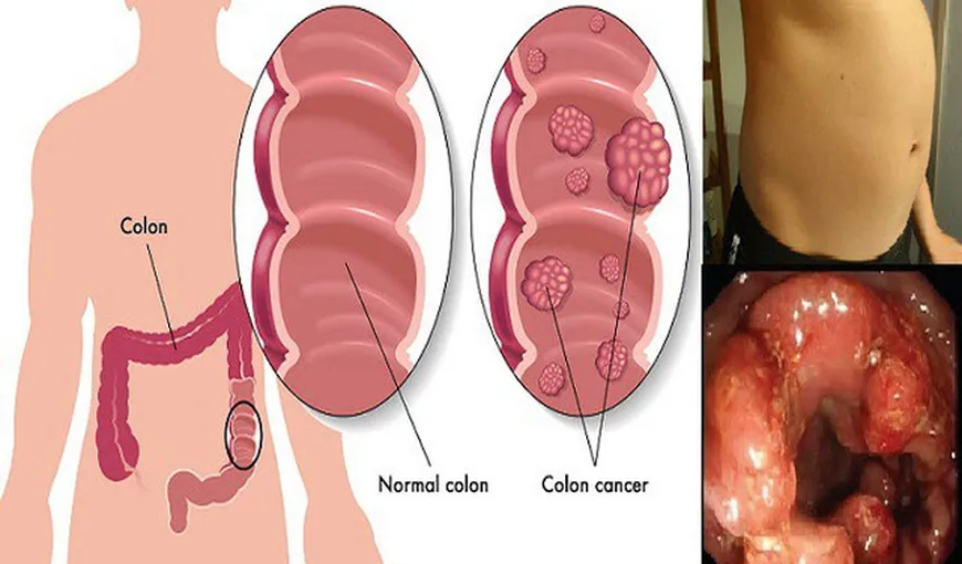 Din 20 de persoane, una prezintă riscul de a face cancer la colon. Iată semnele cutremurătoare ale acestei boli