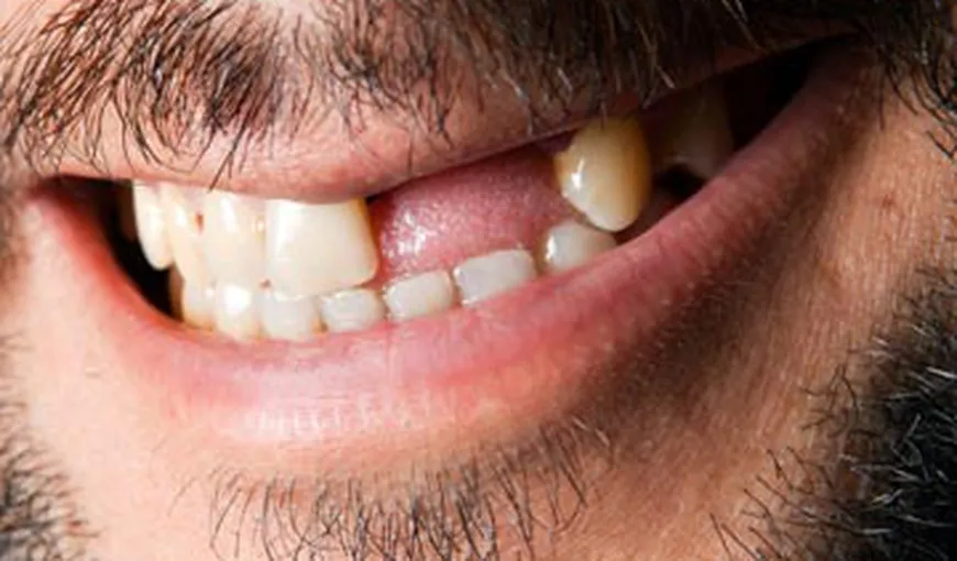 DATE ALARMANTE. Jumătate dintre români îşi pierd dinţii până la 40 de ani