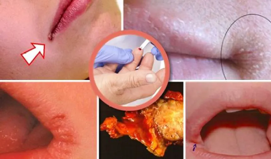 Toate femeile ignoră rănile din colţul gurii, dar uite cât de PERICULOASE pot fi
