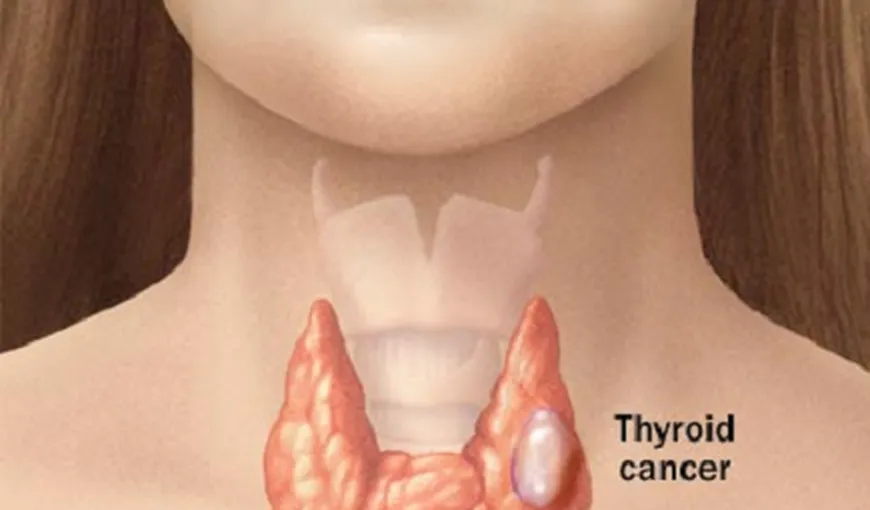 Cancerul de tiroidă. Cine e predispus să dezvolte această boală