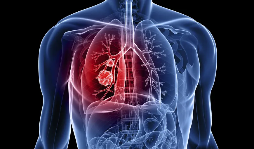 UE a aprobat un nou tip de tratament împotriva cancerului pulmonar