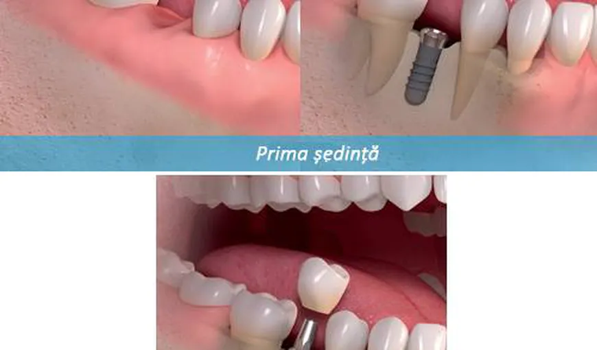 Implantul dentar într-o şedinţă, o procedură atraumatică, rapidă, cu costuri reduse