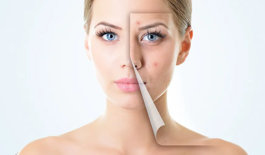 Ce produse cosmetice să foloseşti în funcţie de tipul acneei tale