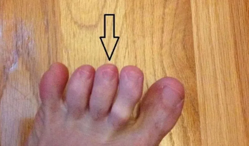 Cancerul de piele poate fi anunţat de degetele de la picioare. Află cum!