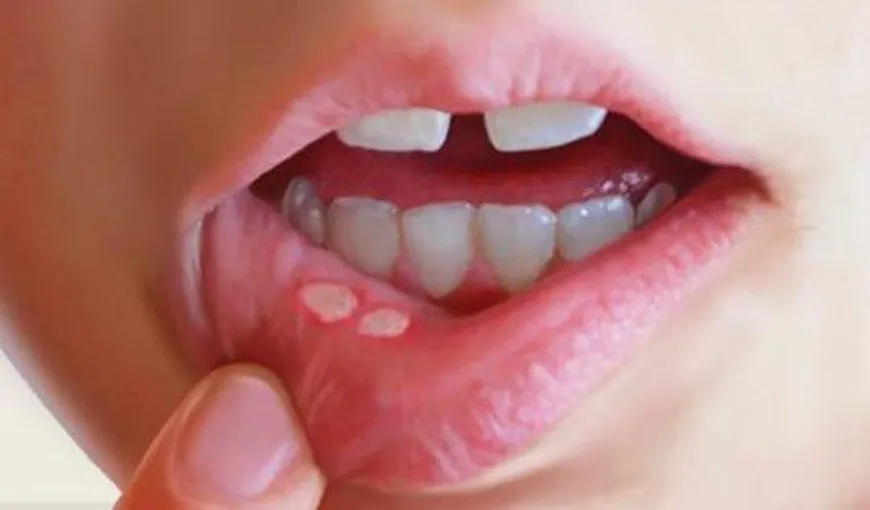 Remedii pentru tratarea aftelor bucale