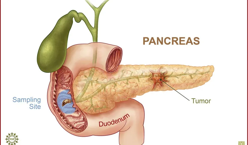 A fost creat primul tratament împotriva cancerului pancreatic, fără efecte secundare