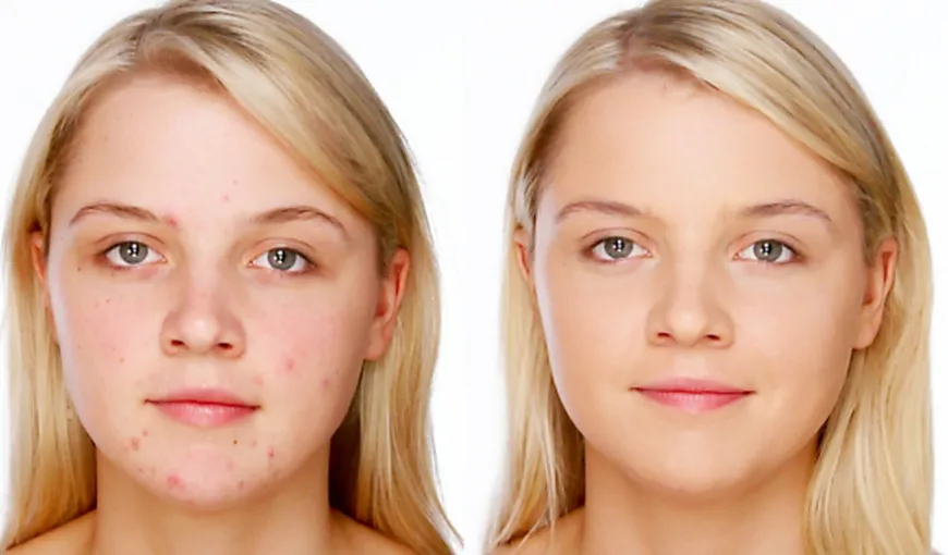 Trucuri de make-up pentru femeile cu acnee