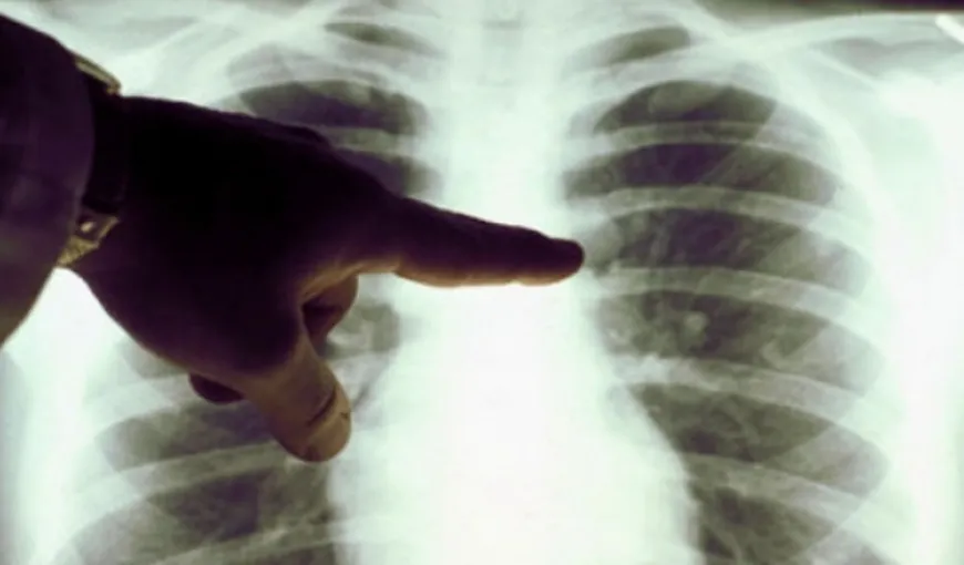 Un nou tratament oferă rezultate promiţătoare împotriva tuberculozei multirezistente