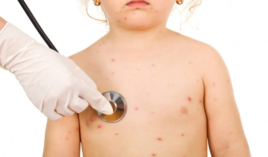 ALERTĂ MEDICALĂ în Gorj! Epidemie de varicelă la o şcoală şi două grădiniţe: 70 de copii, afectaţi