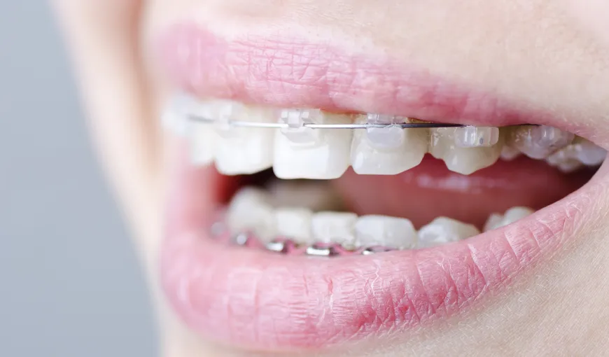 4 trucuri pentru cei care poartă aparat dentar pentru adulţi