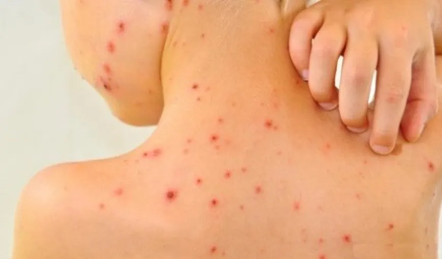 Focar de varicelă la o grădiniţă din Constanţa: 18 copii din aceeaşi grupă s-au îmbolnăvit