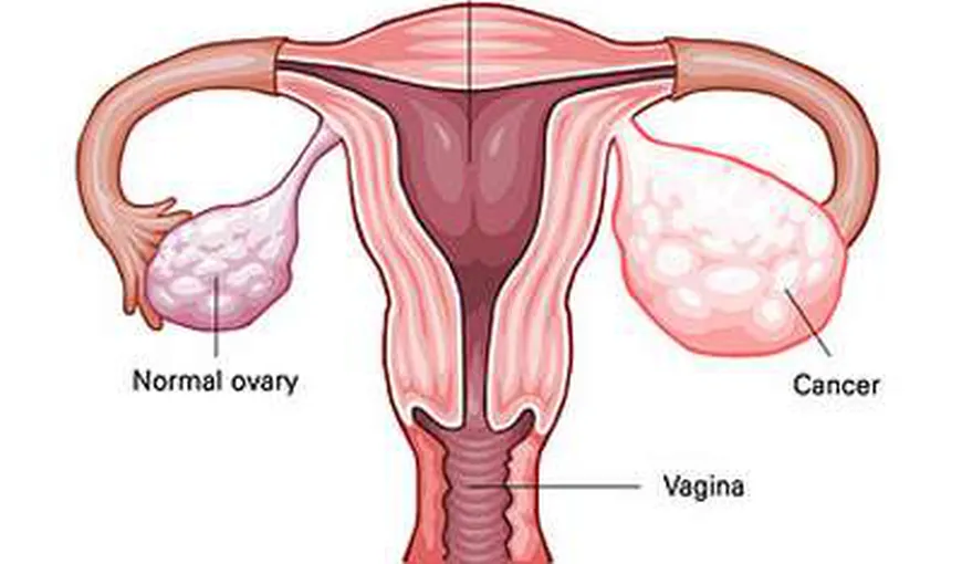 Simptome ale cancerului ovarian pe care nicio femeie nu ar trebui să le ignore