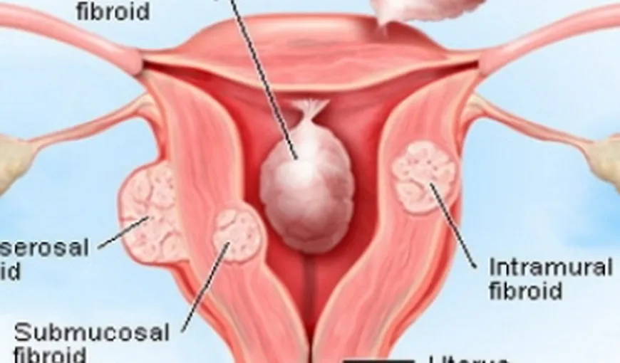 Ce simptome are fibromul uterin şi cum poate fi eliminat în jumătate de oră