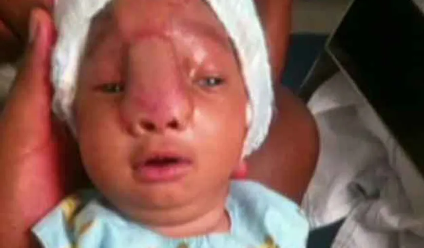 Copilul ăsta s-a născut cu creierul în afara craniului! Cum arată acum, după o operaţie de şase ore care i-a salvat viaţa!