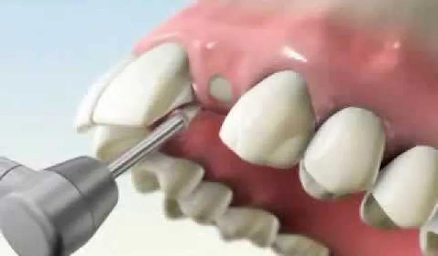 Lipsa unei rădăcini de stimulare a maxilarului poate duce la degradarea oaselor. Vezi cum se face implantul dentar