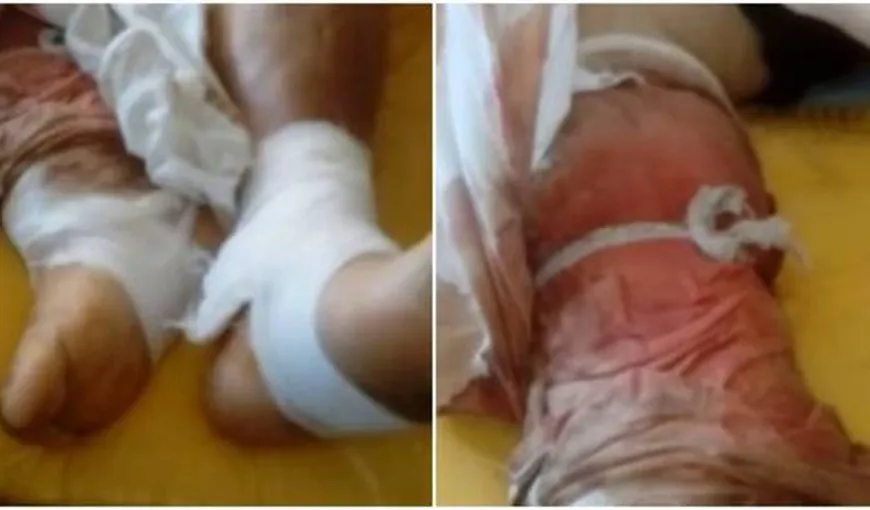 Caz incredibil la un spital din Caransebeş. O pacientă a fost ţinută cu acelaşi pansament timp de câteva zile VIDEO