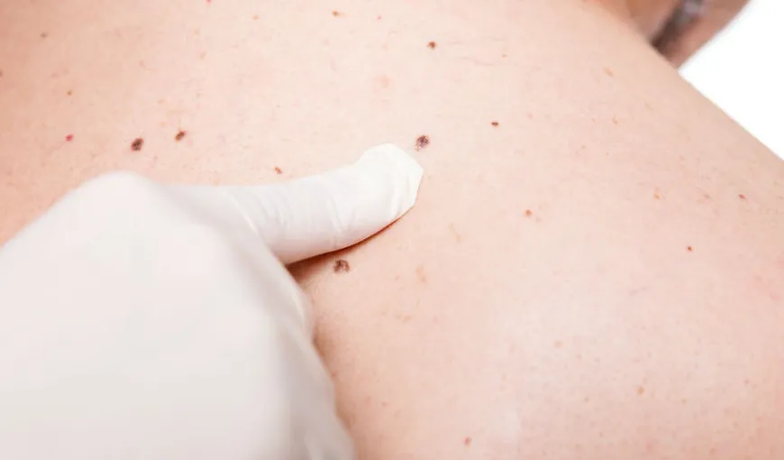Cum ştim dacă aluniţa se transformă în melanom? Iată la ce trebuie să fim atenţi
