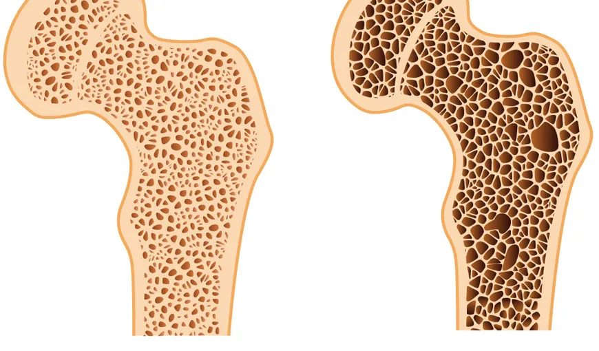 Alimente care ajută la fixarea calciului în oase şi previn osteoporoza