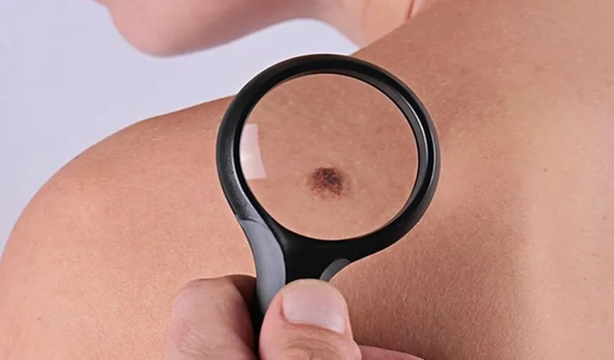 Simptome ascunse ale cancerului de piele