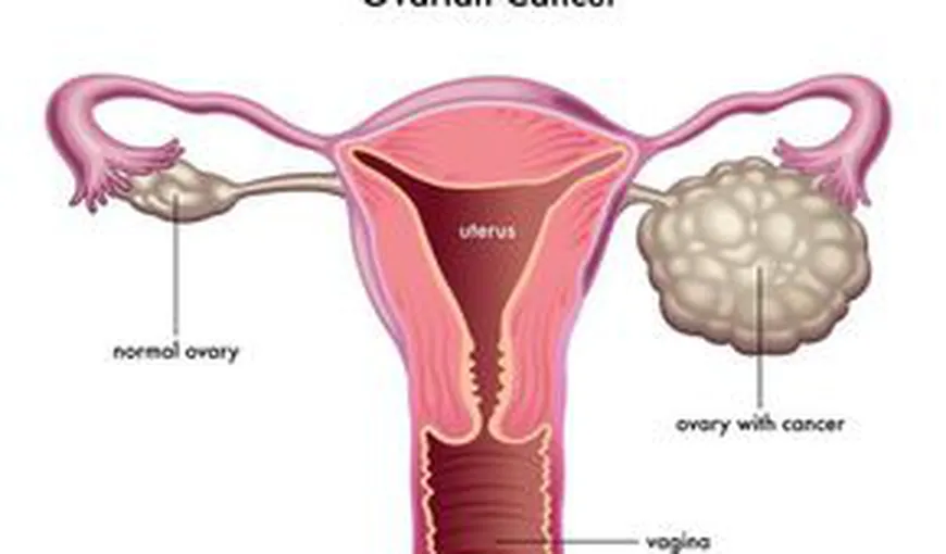 Cancerul ovarian, boala cu cea mai mică rată de supravieţuire dintre toate tipurile de cancer feminin