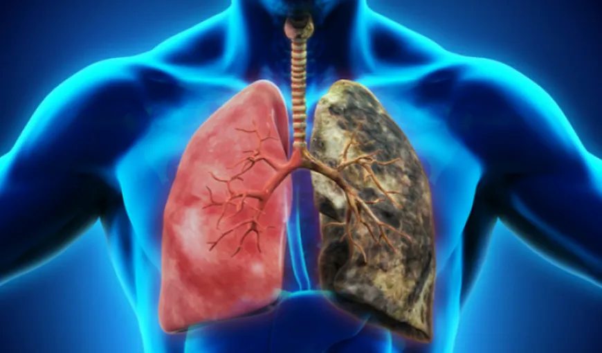 STUDIU: Fumatul, principala cauză a cancerului pulmonar