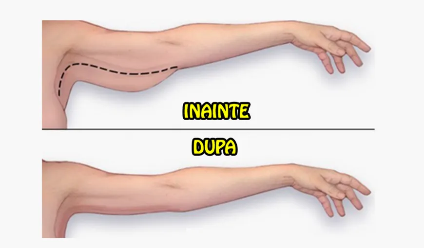 Scapă de pielea lăsată de pe braţe fără chirurgia estetică. Este foarte uşor!