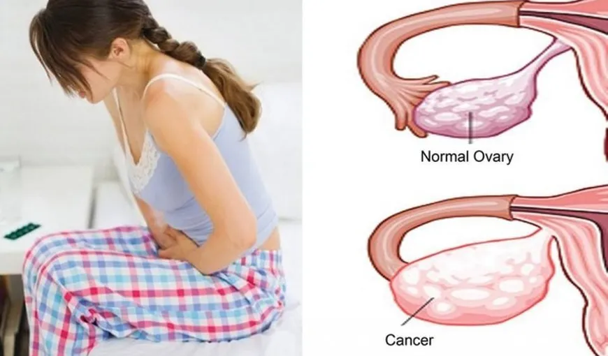 Simptomele cancerului ovarian, „asasinul tăcut” care ucide milioane de femei. Mergi urgent la medic!