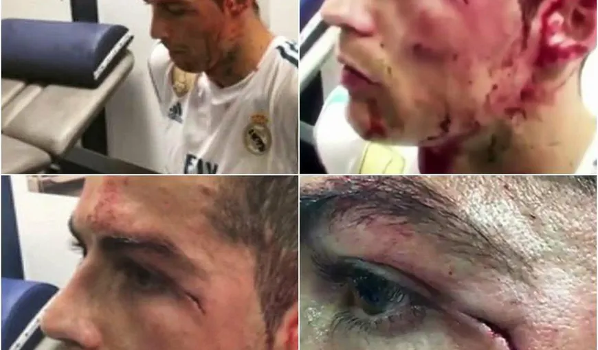 Imagini şocante cu Cristiano Ronaldo, a fost desfigurat cu crampoanele VIDEO