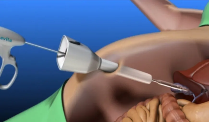 Tehnică medicală inovativă pentru chirurgia vezicii biliare