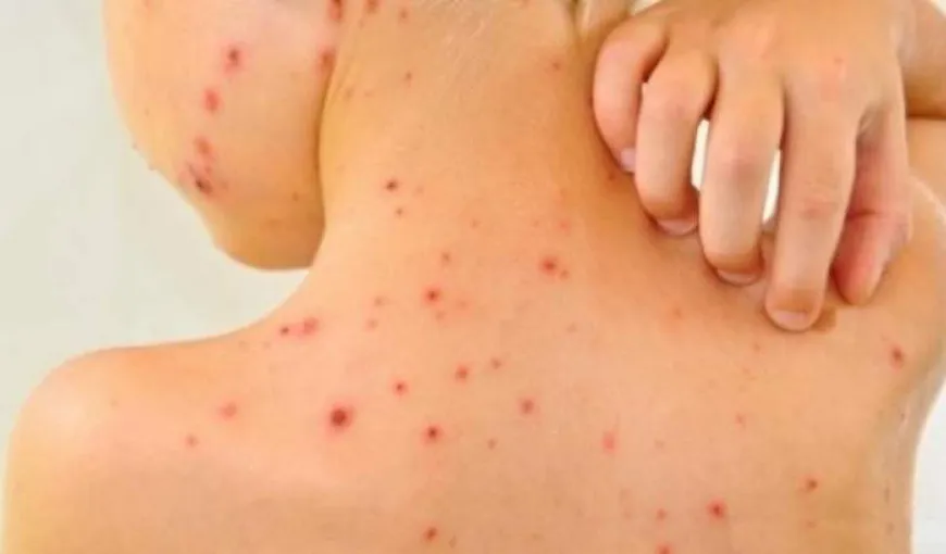 Cele mai comune probleme de piele la copii