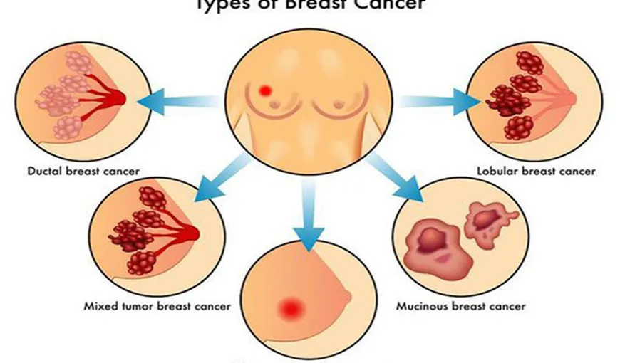 Răspândirea cancerului de sân în alte organe poate fi stopată. Ce spun specialiştii