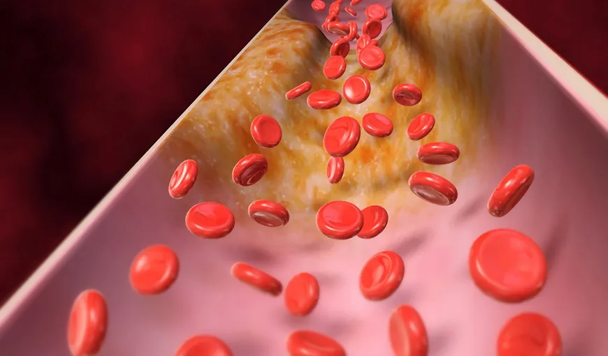 Sfaturi practice de sănătate! Cum îţi poţi curăţa colesterolul din vasele de sânge în doar 40 de zile