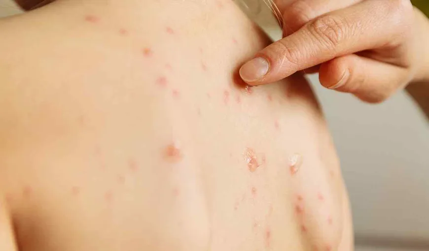 Alertă medicală în Olt! Şase focare de varicelă în şcolile din judeţ