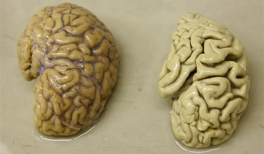 Un nou studiu ar putea detecta boala Alzheimer cu 15 ani înainte de apariţia simptomelor